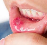 Oral Infections: Prevention Do's and Don'ts