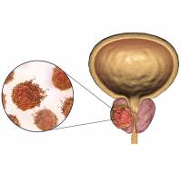 5 year survival rate in prostate cancer