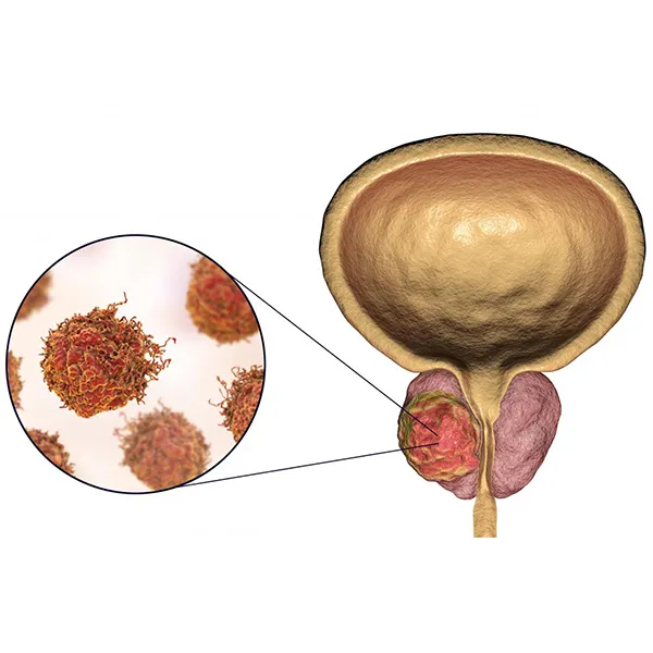 5 year survival rate in prostate cancer