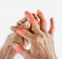 Arthritis: A Common Joint Disorder