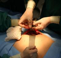 Can a person with acute appendicitis have normal appendix during surgery?