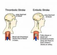 Difference between an embolic stroke and a thrombotic stroke?