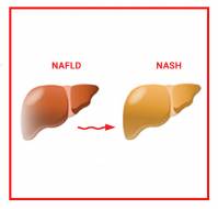 Understanding NASH and NAFLD: How do you differentiate?