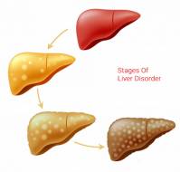 What are the stages of liver disease ?