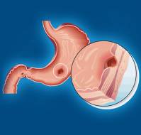 How can one evaluate peptic ulcer disease?
