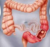 How common is cancer of the colon?