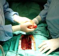 How difficult is cardiac transplant?