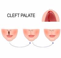 How do you treat a Cleft lip and a Cleft Palate?