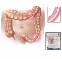 How is Irritable bowel syndrome related to stress?