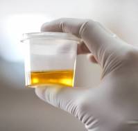 How should we collect urine for tests?