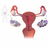 How should we proceed once we suspect PCOS?
