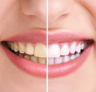 How to remove Brown Stain from Teeth