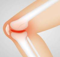 How common is osteoarthritis knee in india?