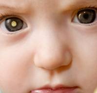How is cataract managed in children?