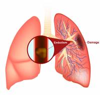 How is pulmonary embolism diagnosed?