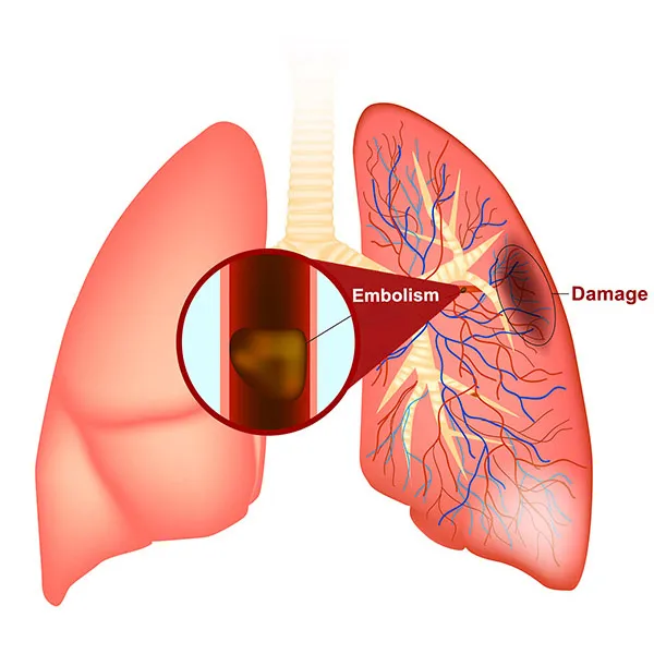 How is pulmonary embolism diagnosed?