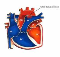 Intervention in a case with PDA (Patent Ductus Arteriosus)?