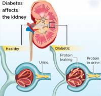 Kidney diseases in diabetes patients?