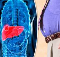 Liver Disease in Obesity
