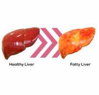 NAFLD & Diabetes