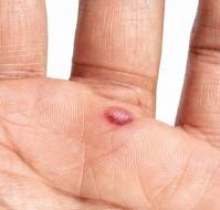 ब्लड ब्लिस्टर क्या होता है? कारण, लक्षण और इलाज | Blood Blister in Hindi