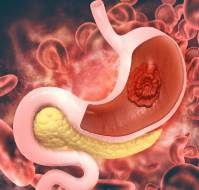 Peptic Ulcers: Causes, Symptoms and Treatment