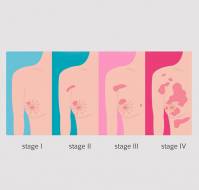 What is staging in Breast Cancer?