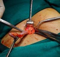 Surgical management of acute appendicitis?