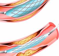 What are the first generation stents?