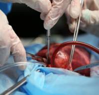 What are the long term results of cardiac transplant?