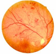 What are the risk factors that lead to Diabetic Retinopathy?