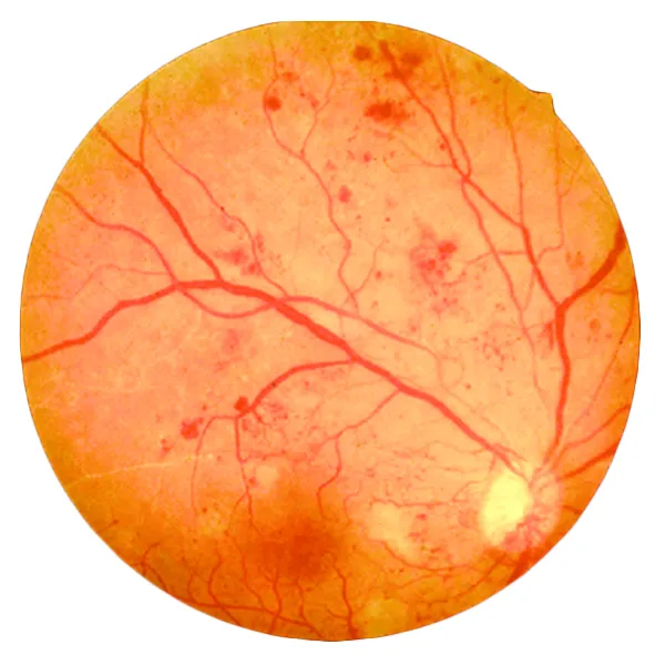 What are the risk factors that lead to Diabetic Retinopathy?