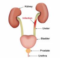 What can cause recurrent urinary infections?