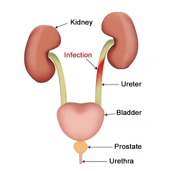 What can cause recurrent urinary infections?