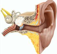 What happens if surgery is not done for unsafe CSOM or cholesteatoma?