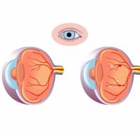 What is diabetic retinopathy?