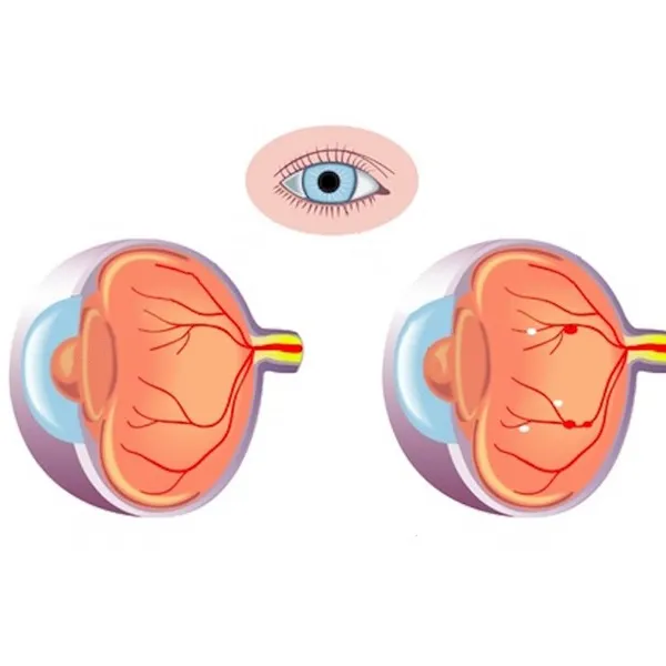 What is diabetic retinopathy?