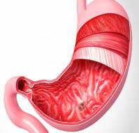 What is peptic ulcer?