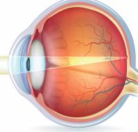 What is refractive error and what are the causes of refractive error?