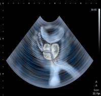 What is residual urine when we examine ultrasound of a prostate?