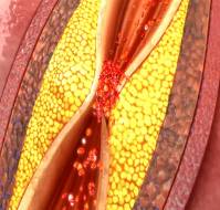 What is stable coronary artery disease?
