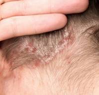 What is the cure for Psoriasis?