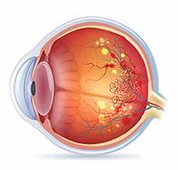 What is the impact of high blood pressure on retina?