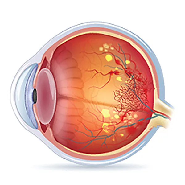 What is the impact of high blood pressure on retina?