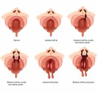 What is the incidence of Wilsons disease?