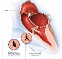 What is the most common cause of aortic regurgitation?