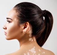 What is vitiligo?