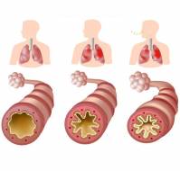 What management of status asthmaticus?