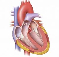 What precaution should we take when we are dealing with the patient of acute heart attack?