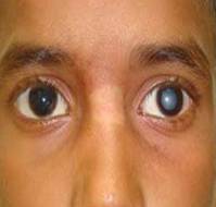 What about Cataract in children?